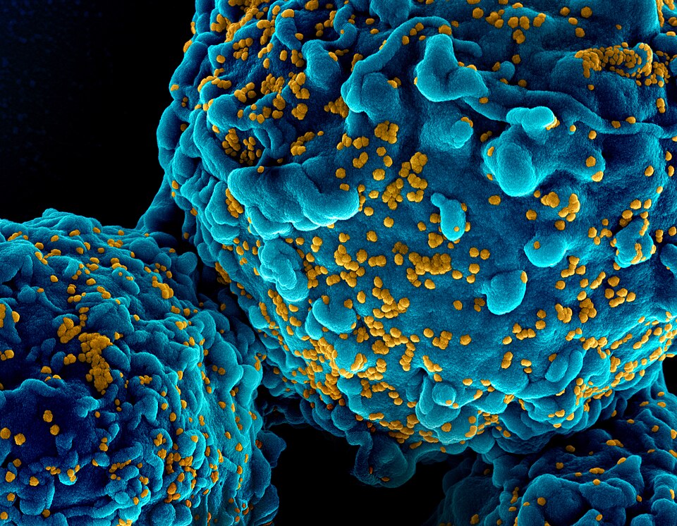 Colorized scanning electron micrograph showing HIV-1 virus particles (yellow) budding from and attached to a human lymphocyte cell (teal)