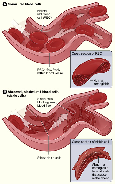 Diagram comparing normal round red blood cells flowing freely with sickled crescent-shaped red blood cells blocking a blood vessel