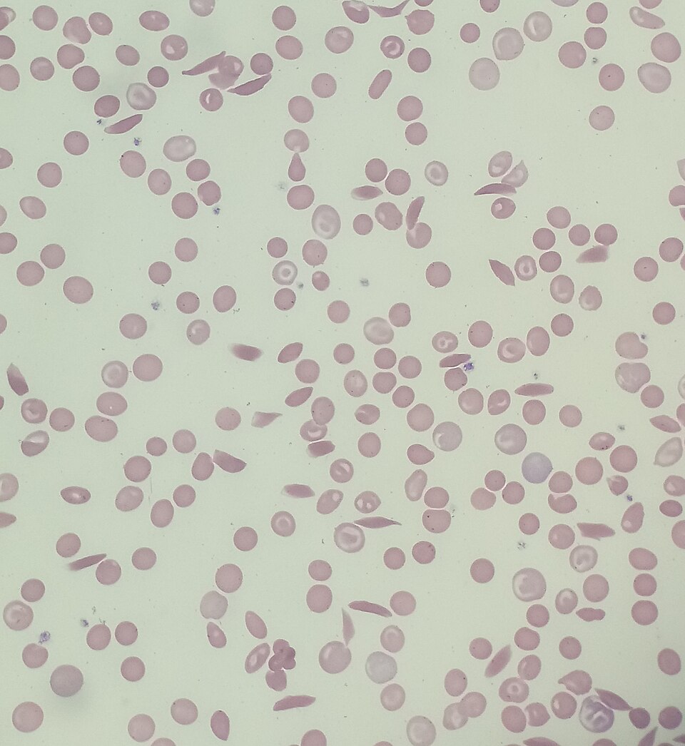Blood smear showing sickle-shaped red blood cells alongside normal round red blood cells