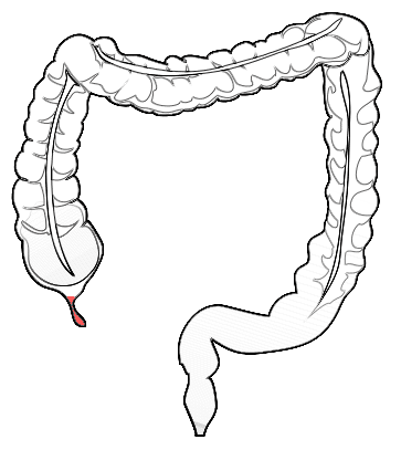 Anatomy diagram showing the location of the vermiform appendix at the junction of the small and large intestine
