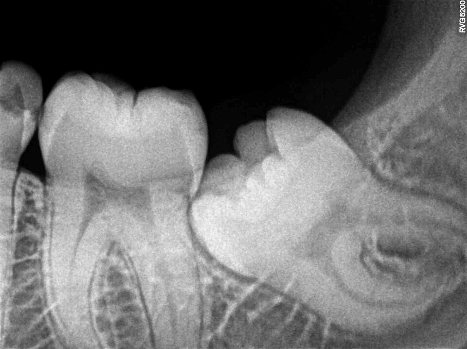 Dental X-ray showing an impacted lower left third molar (wisdom tooth) tilted against the adjacent second molar